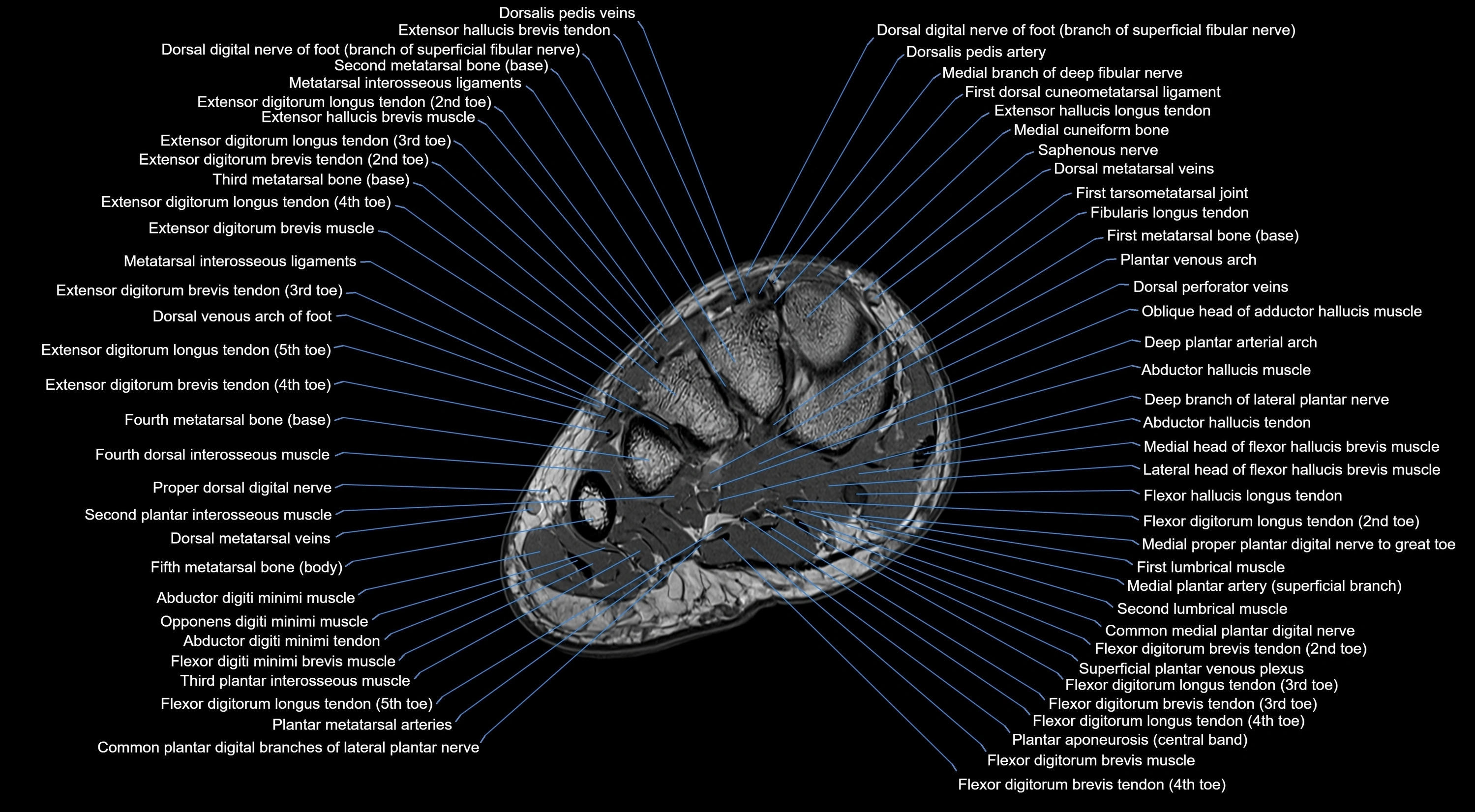 MRI mid foot coronal ligaments cross sectional anatomy 3T  radiology  image-img-00001-00013.webp